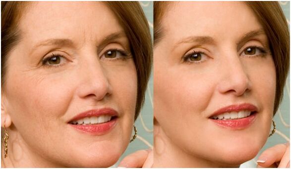 vor und nach der Plasma-Gesichtshautverjüngung