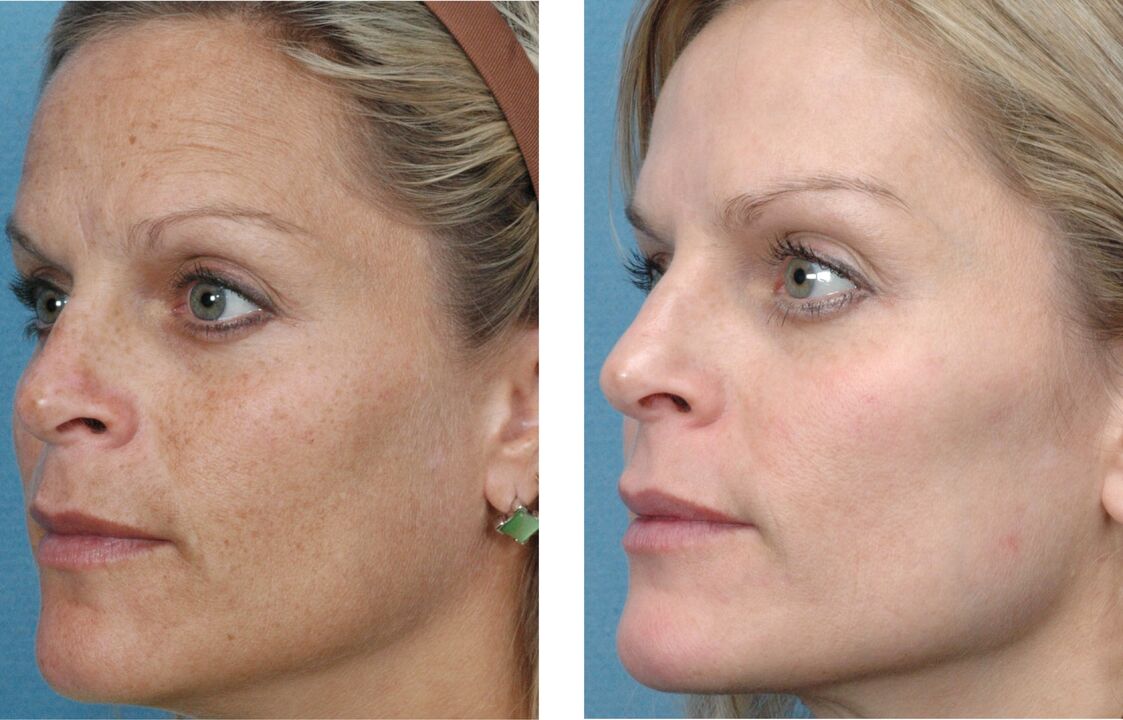 vor und nach der Hautverjüngung Foto 1