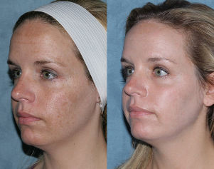 Vor und nach dem Bruch Verjüngung des Gesicht
