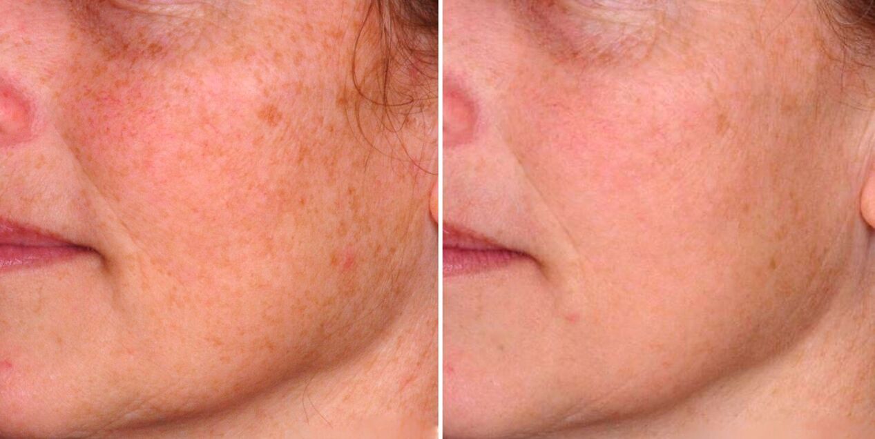Das Ergebnis der fraktionierten Photothermolyse ist die Reduzierung von Altersflecken auf der Gesichtshaut. 