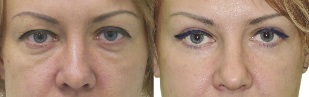 Vorher und nachher Fotos der Augenlidkontur